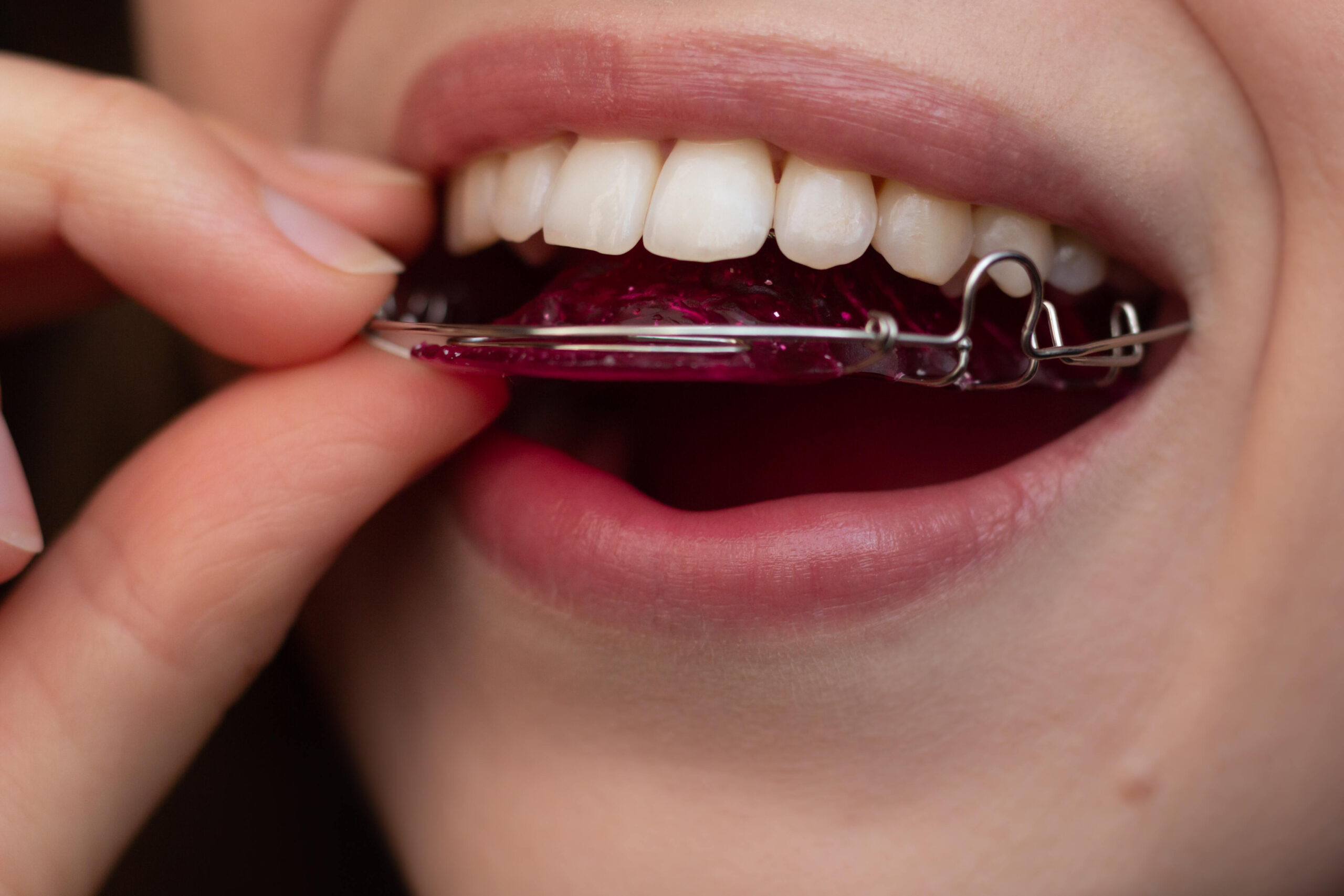 Hawley retainers, or wire retainers, made of acrylic and metal wire, designed for comfort and support, customizable with various colors and designs.
